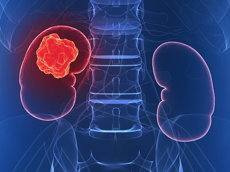 10 Interesting Facts About Kidney Cancer Hrfnd - vrogue.co